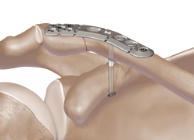 Arthrex - Knotless Distal Clavicle Plate Button Assembly